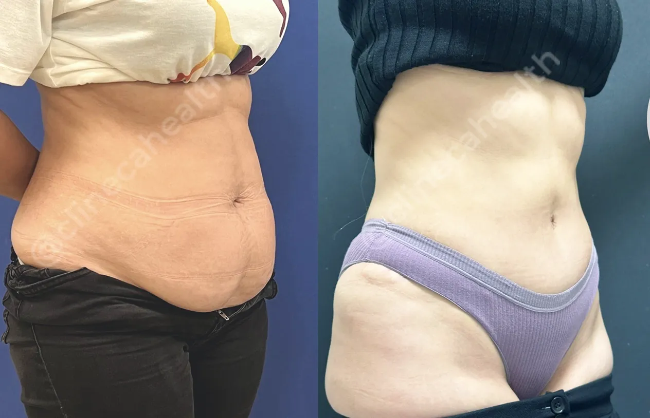 Abdominoplasty — before and after