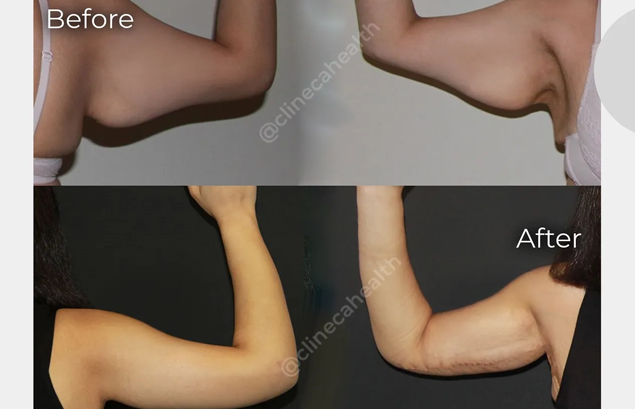 Arm Lift — before and after