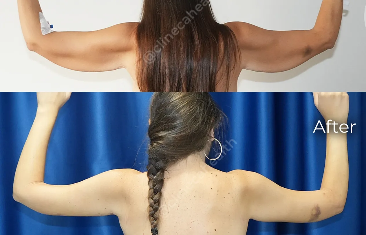 Arm Lift — before and after