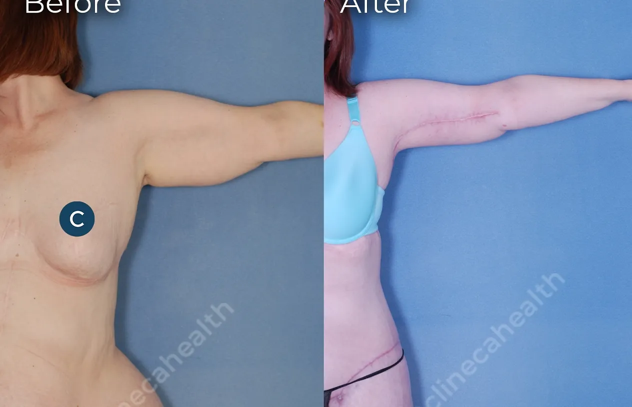 Arm Lift — before and after