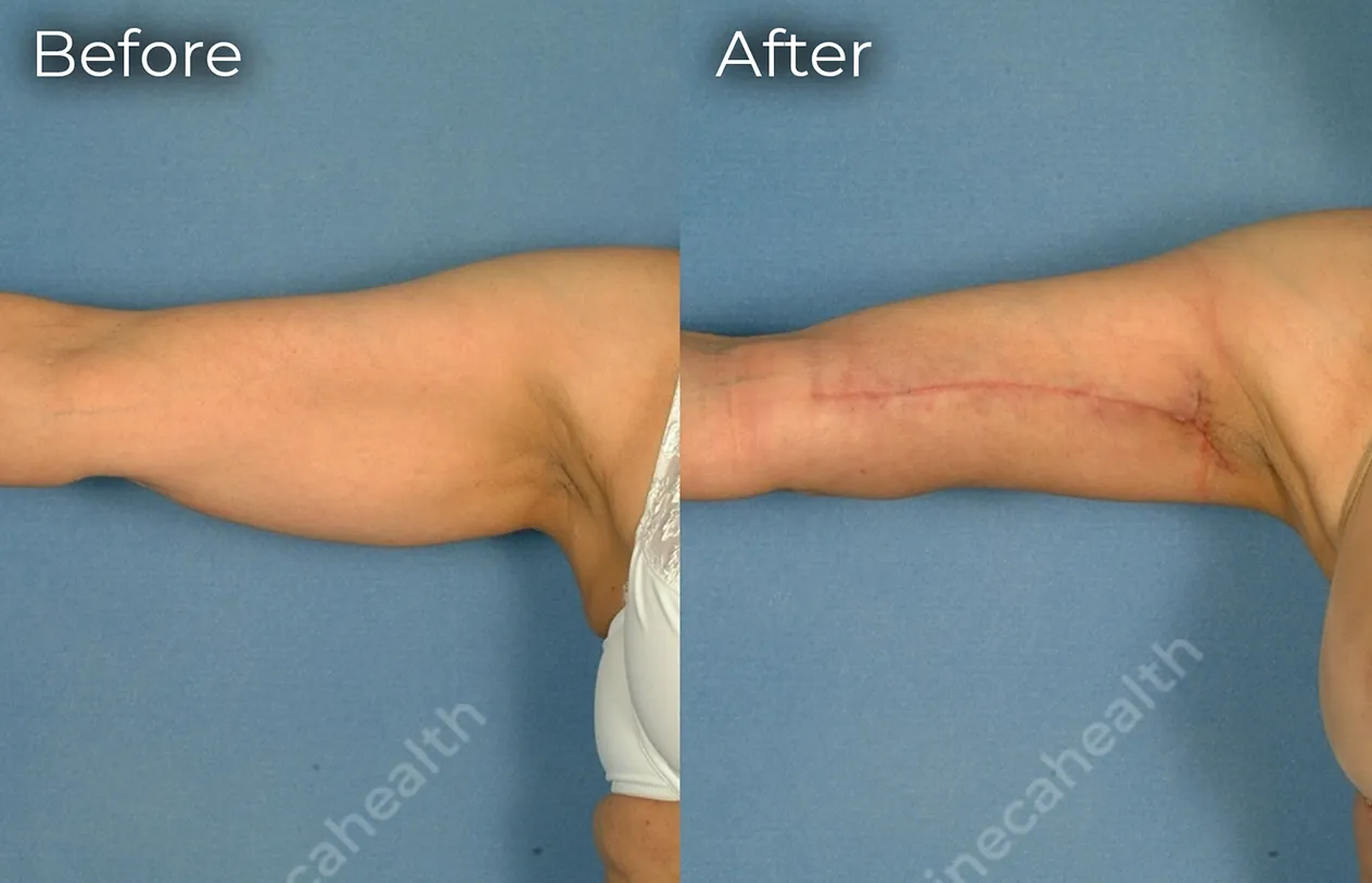 Arm Lift — before and after