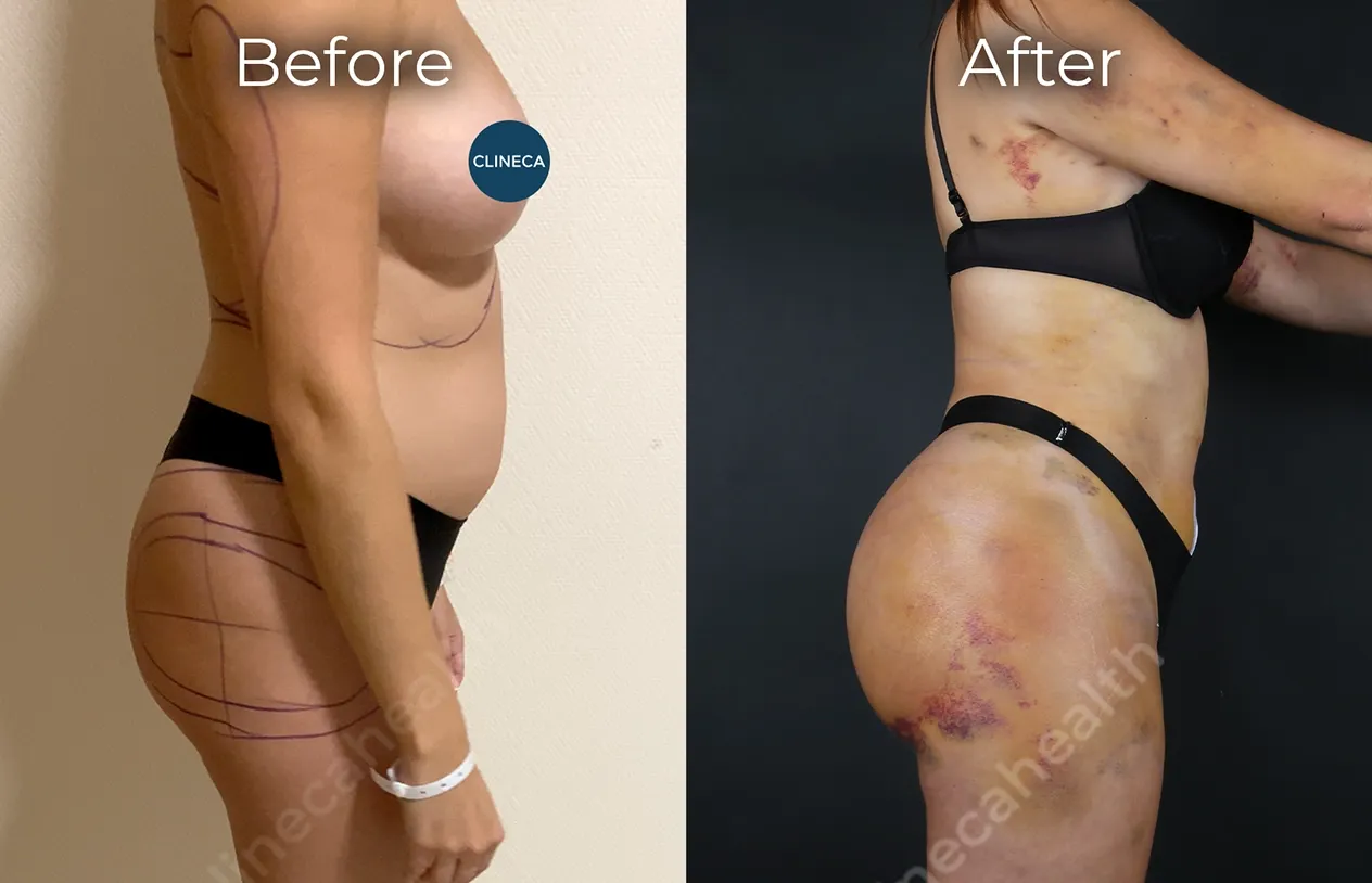 Brazilian Butt Lift — before and after