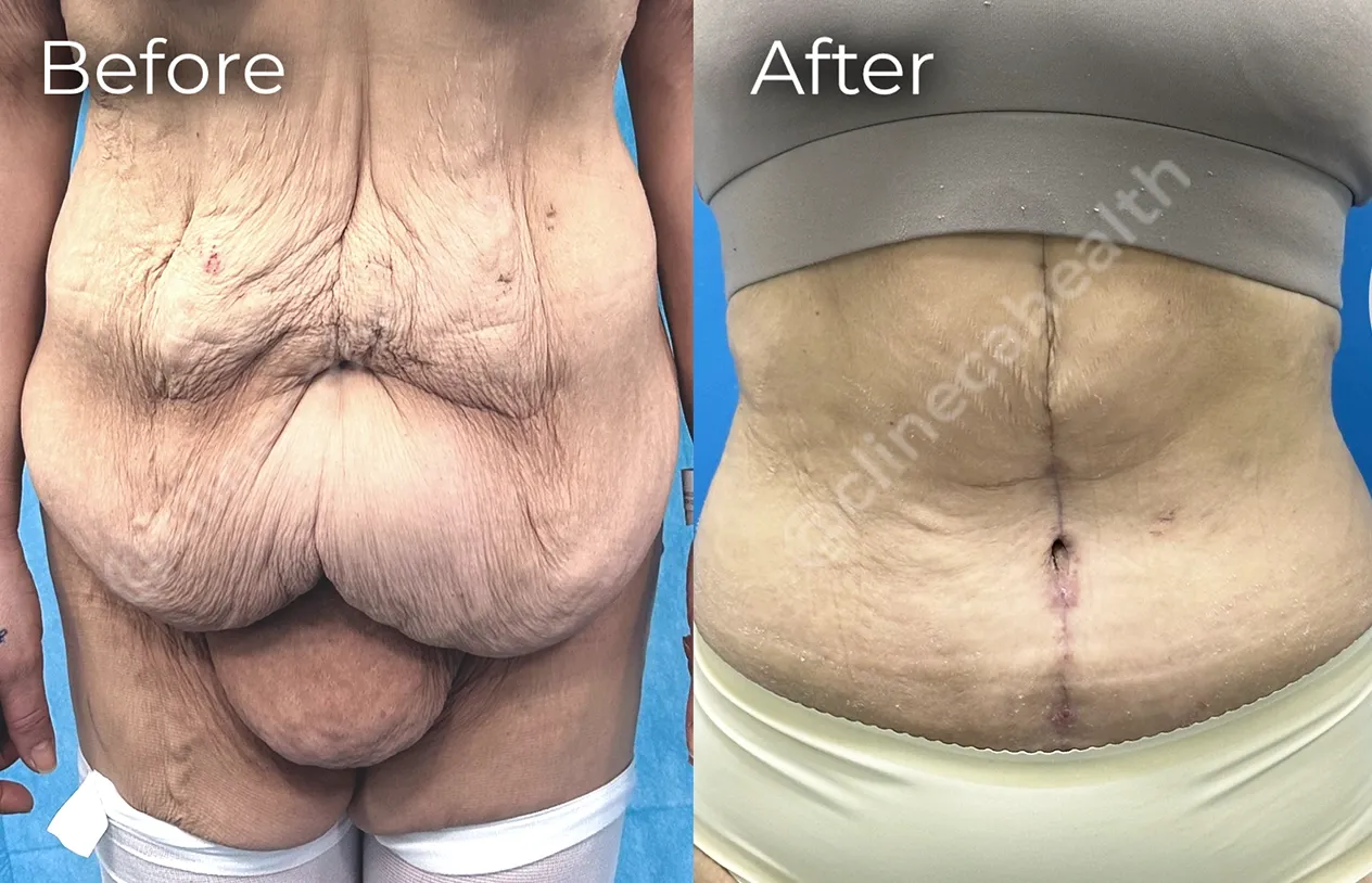 Abdominoplasty — before and after