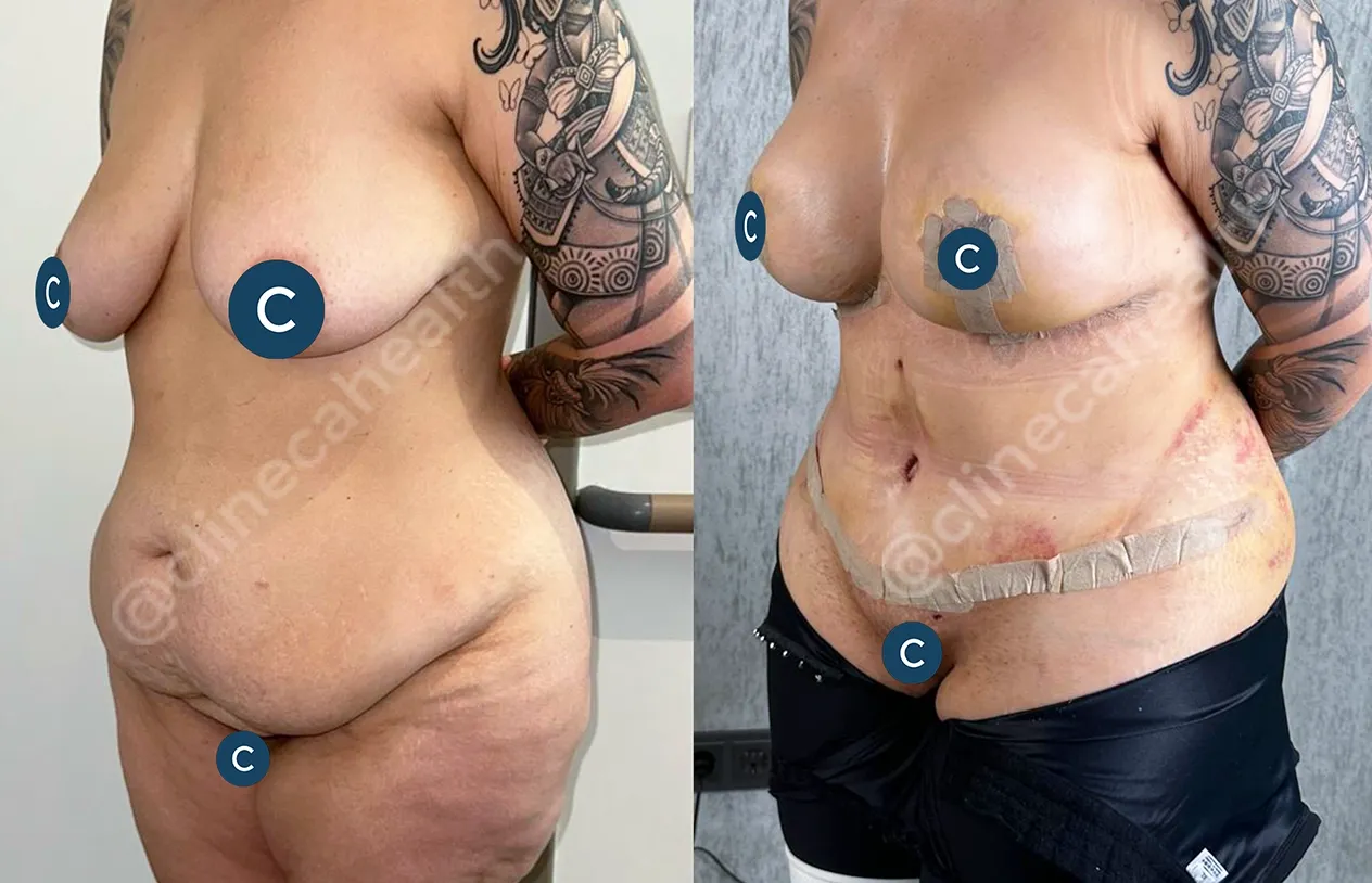 Abdominoplasty — before and after