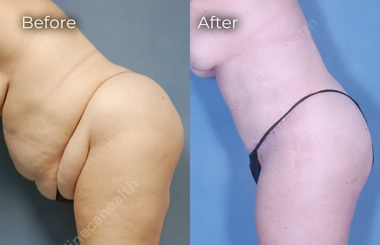 Abdominoplasty — before and after