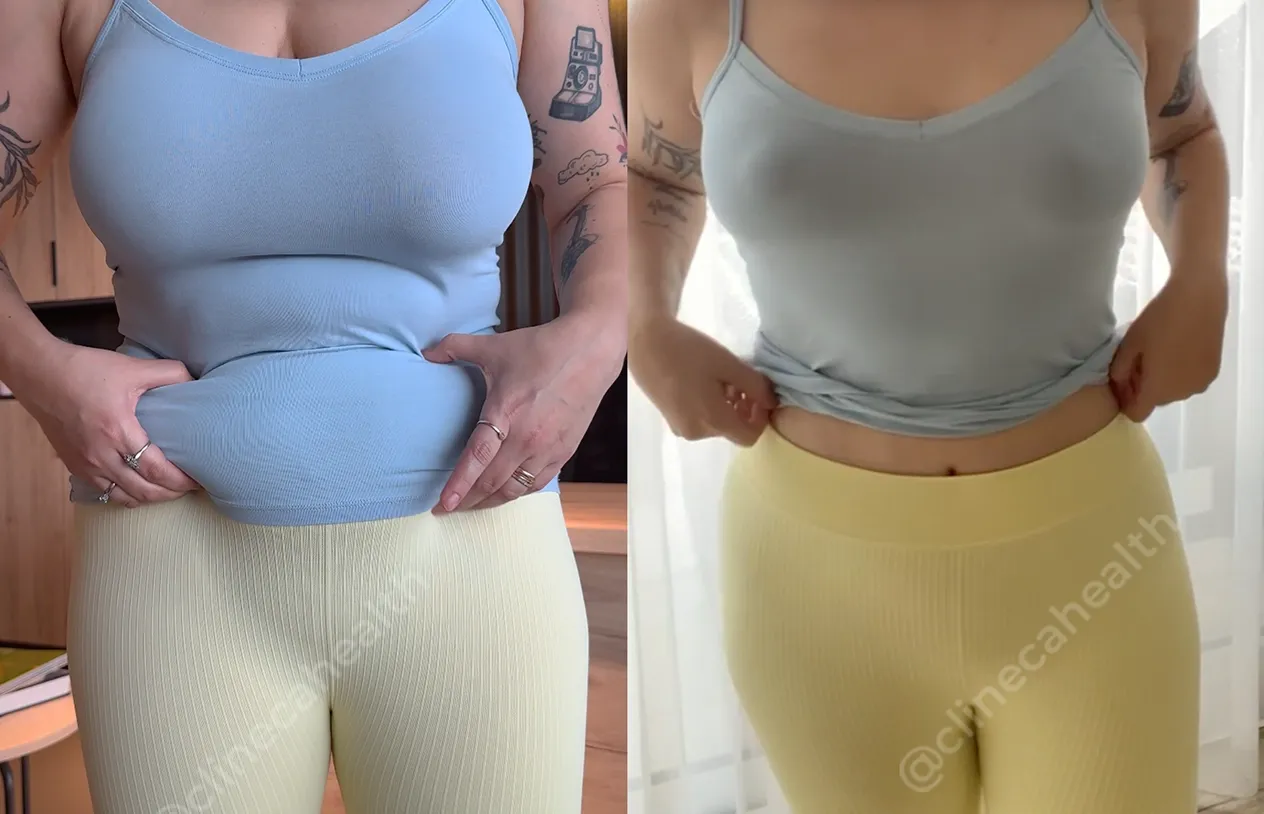 Abdominoplasty — before and after