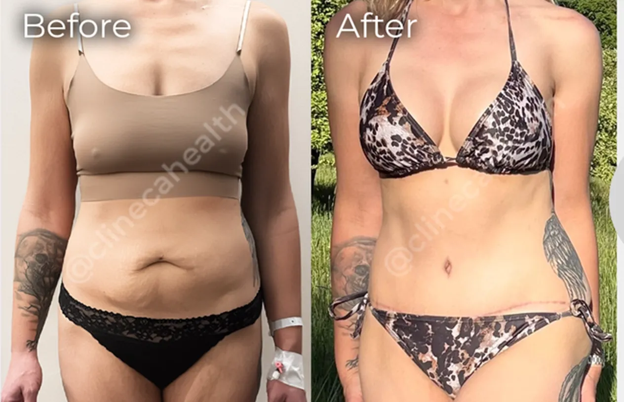 Abdominoplasty — before and after