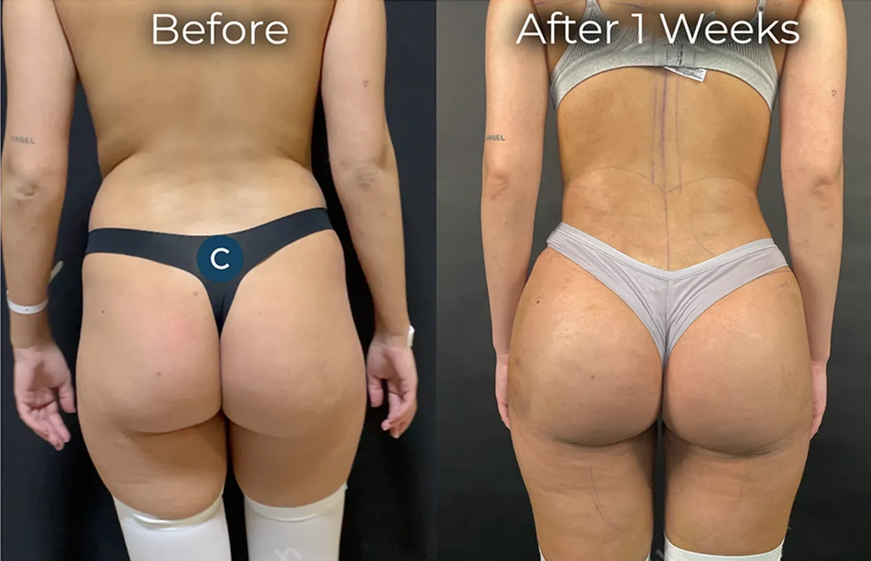Brazilian Butt Lift — before and after