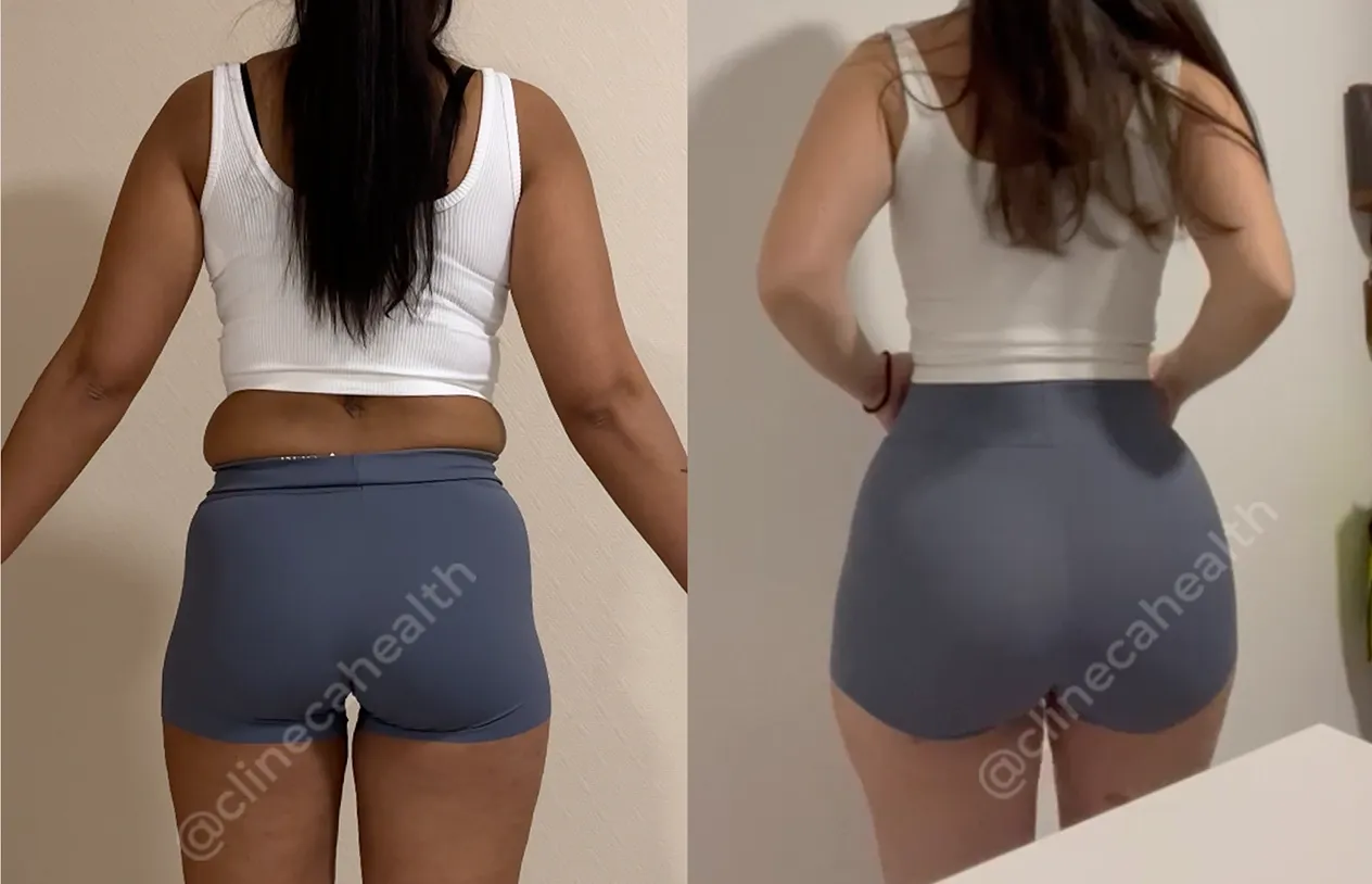 Brazilian Butt Lift — before and after
