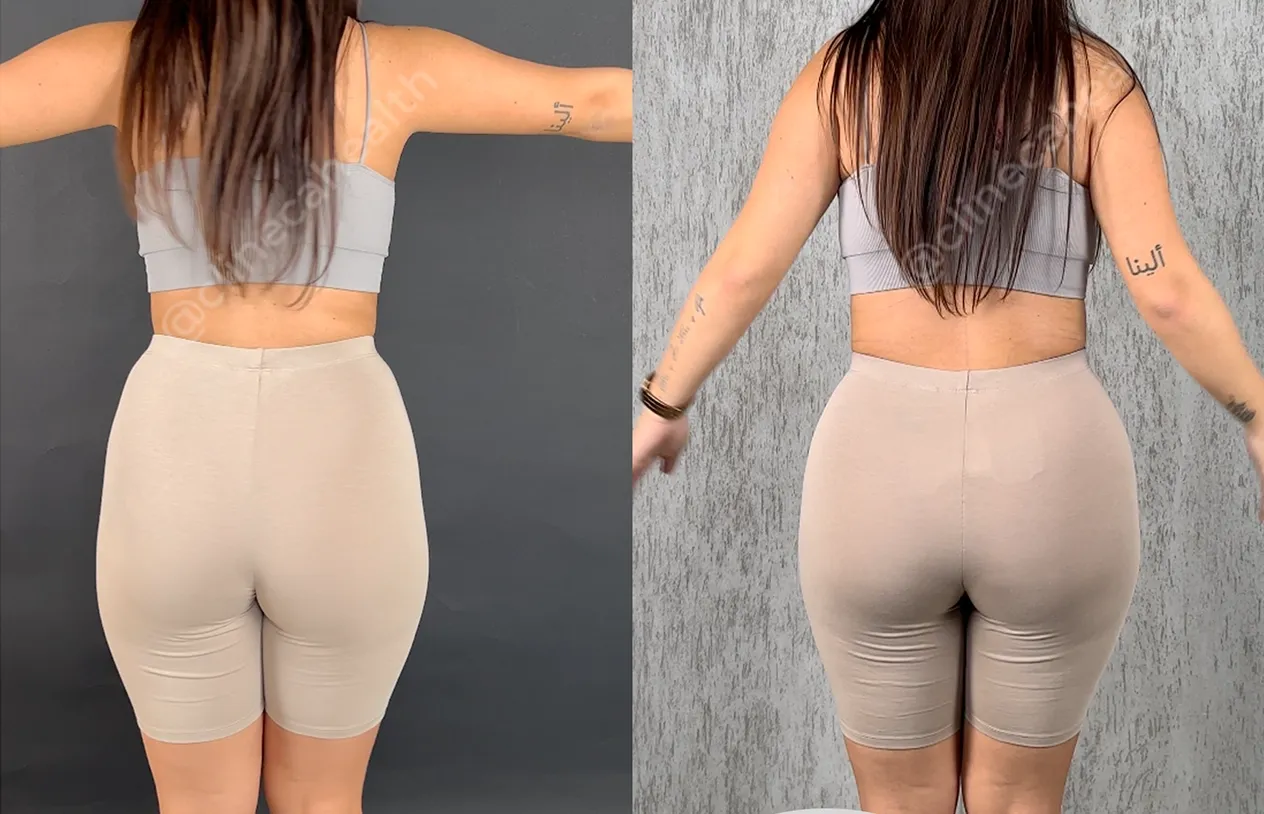 Brazilian Butt Lift — before and after