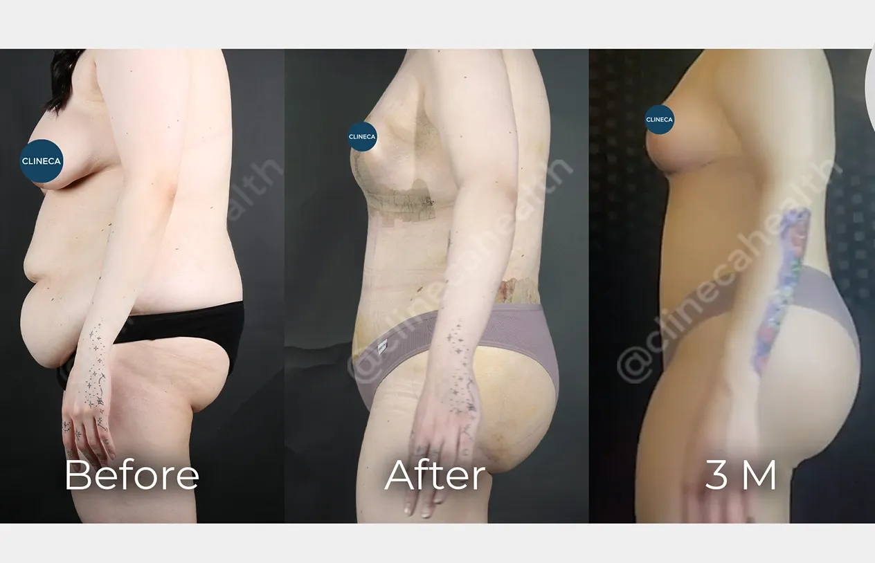 Body Lift — before and after