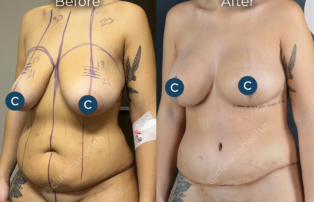 Body Lift — before and after