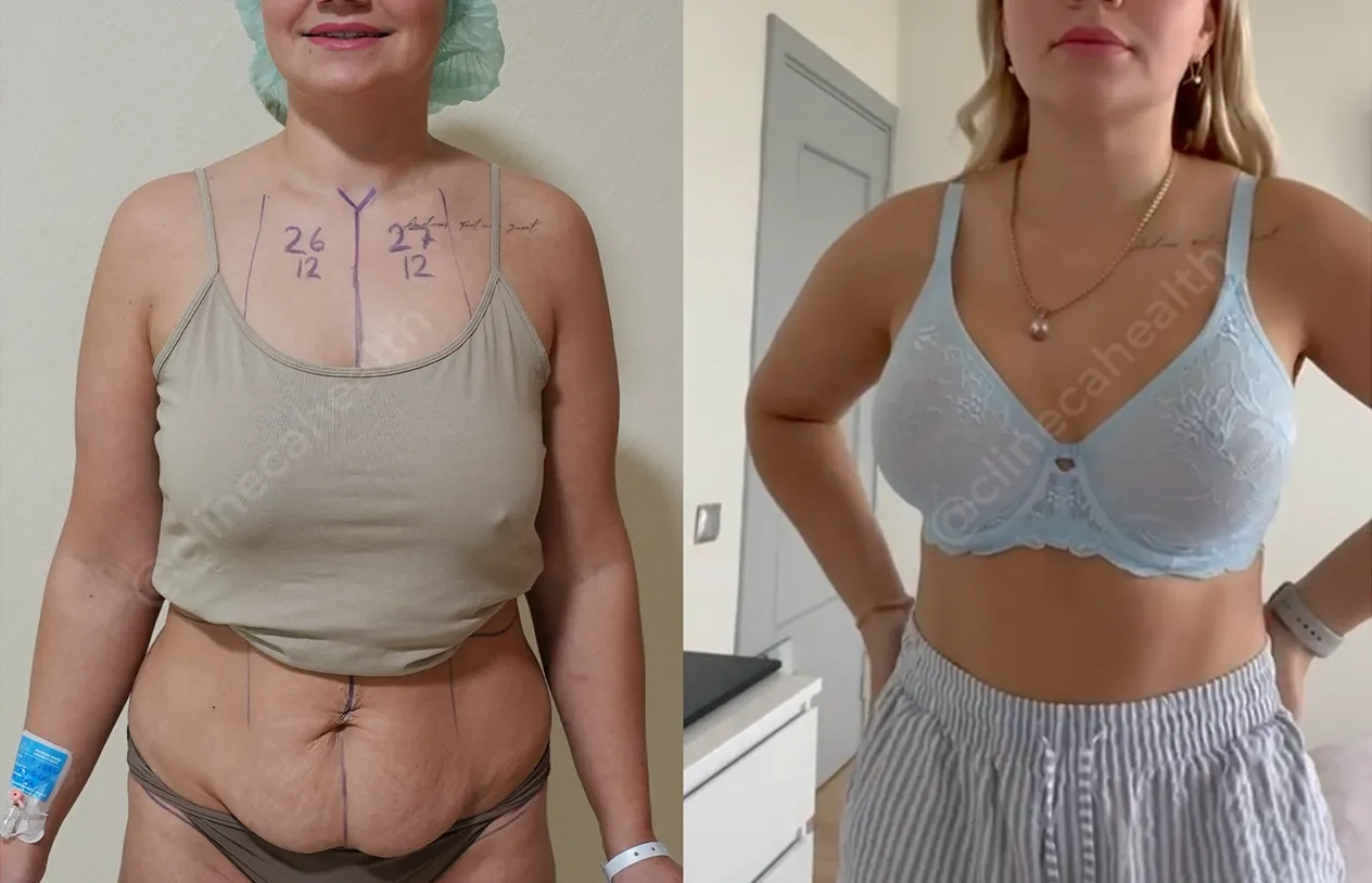 Body Lift — before and after