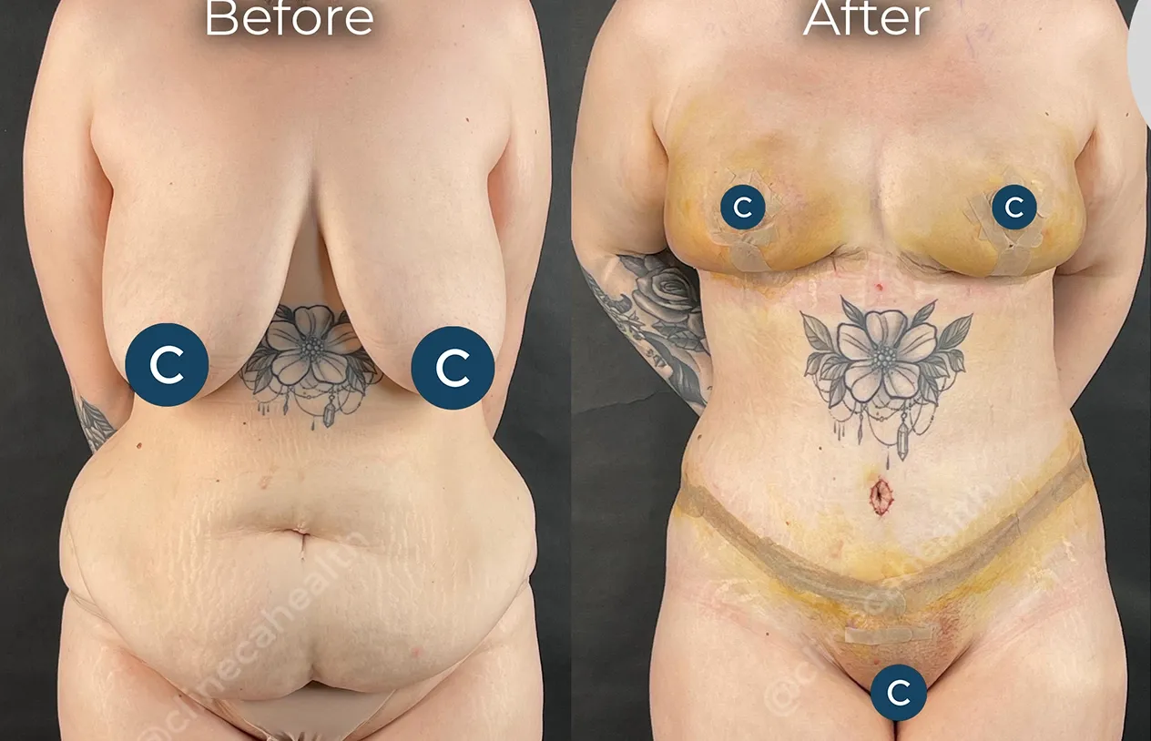 Body Lift — before and after
