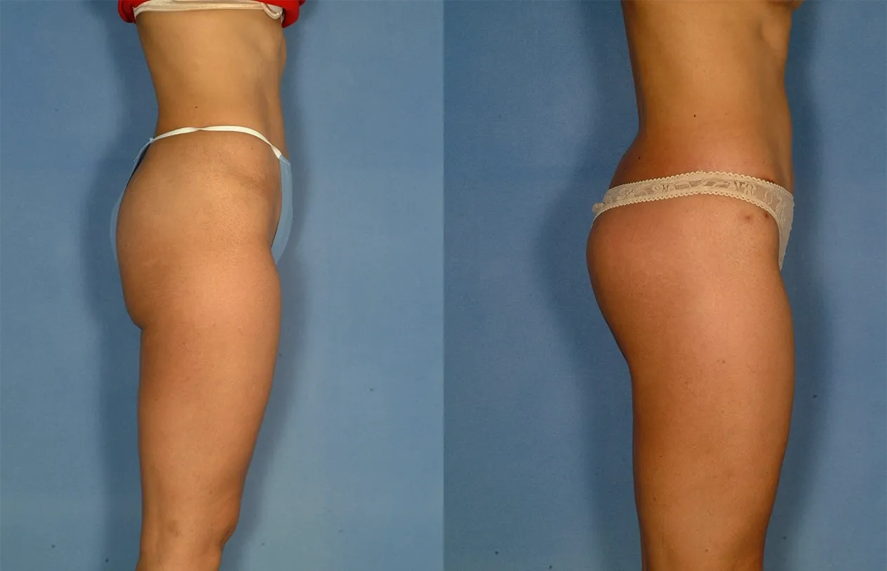 Buttock Augmentation — before and after
