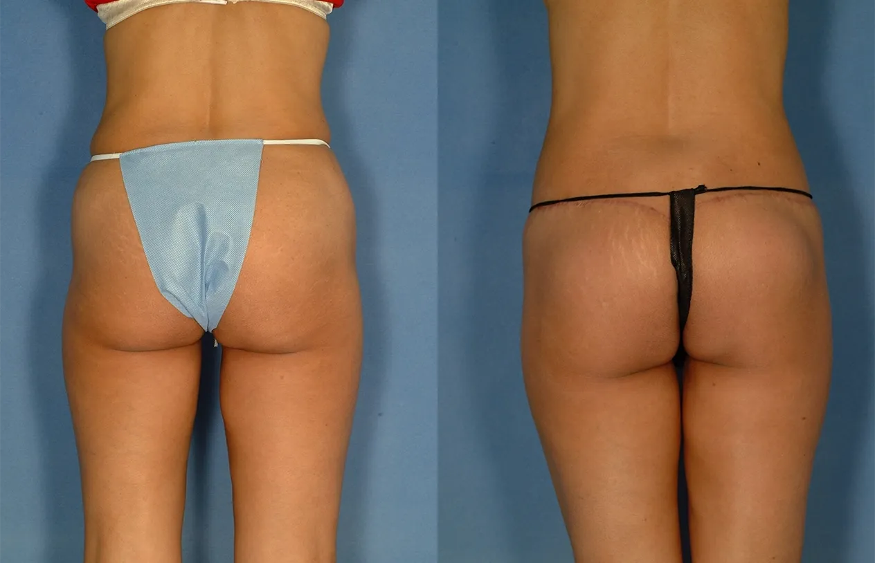 Buttock Augmentation — before and after