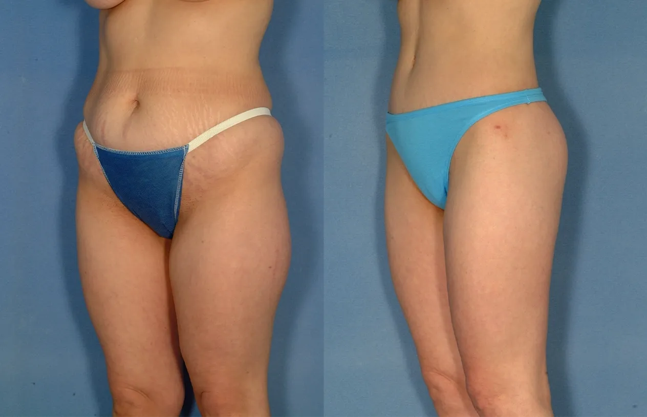 Buttock Augmentation — before and after