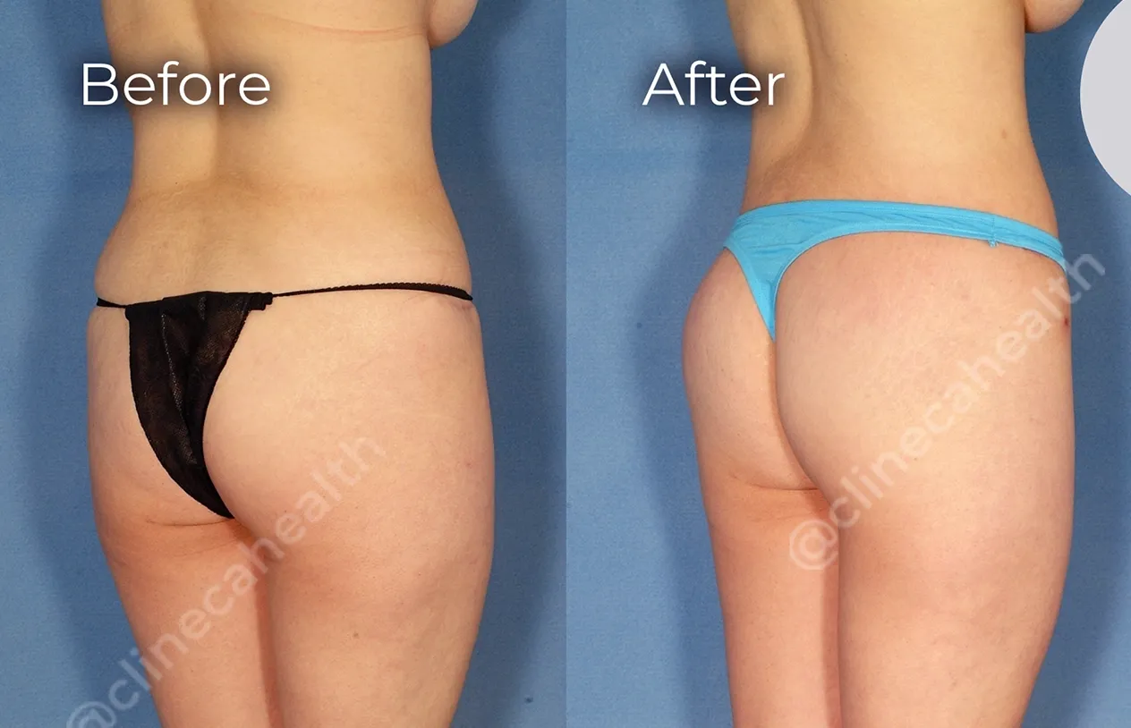 Buttock Lift — before and after