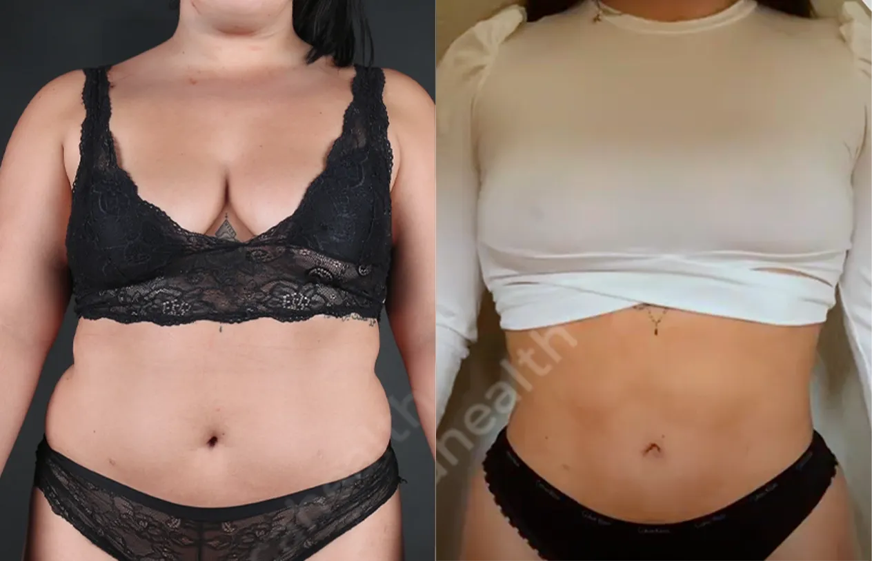 Liposuction — before and after