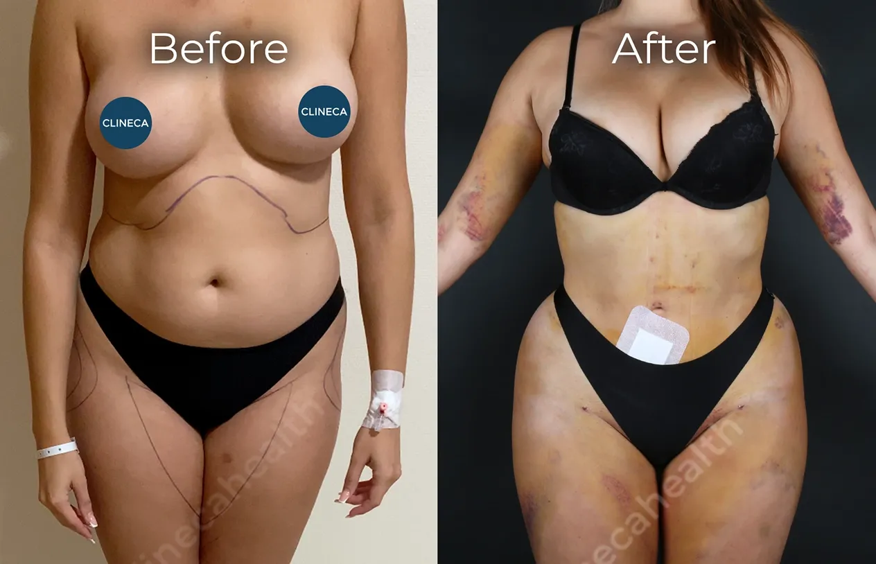 Liposuction — before and after