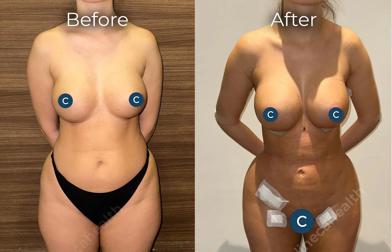 Liposuction — before and after