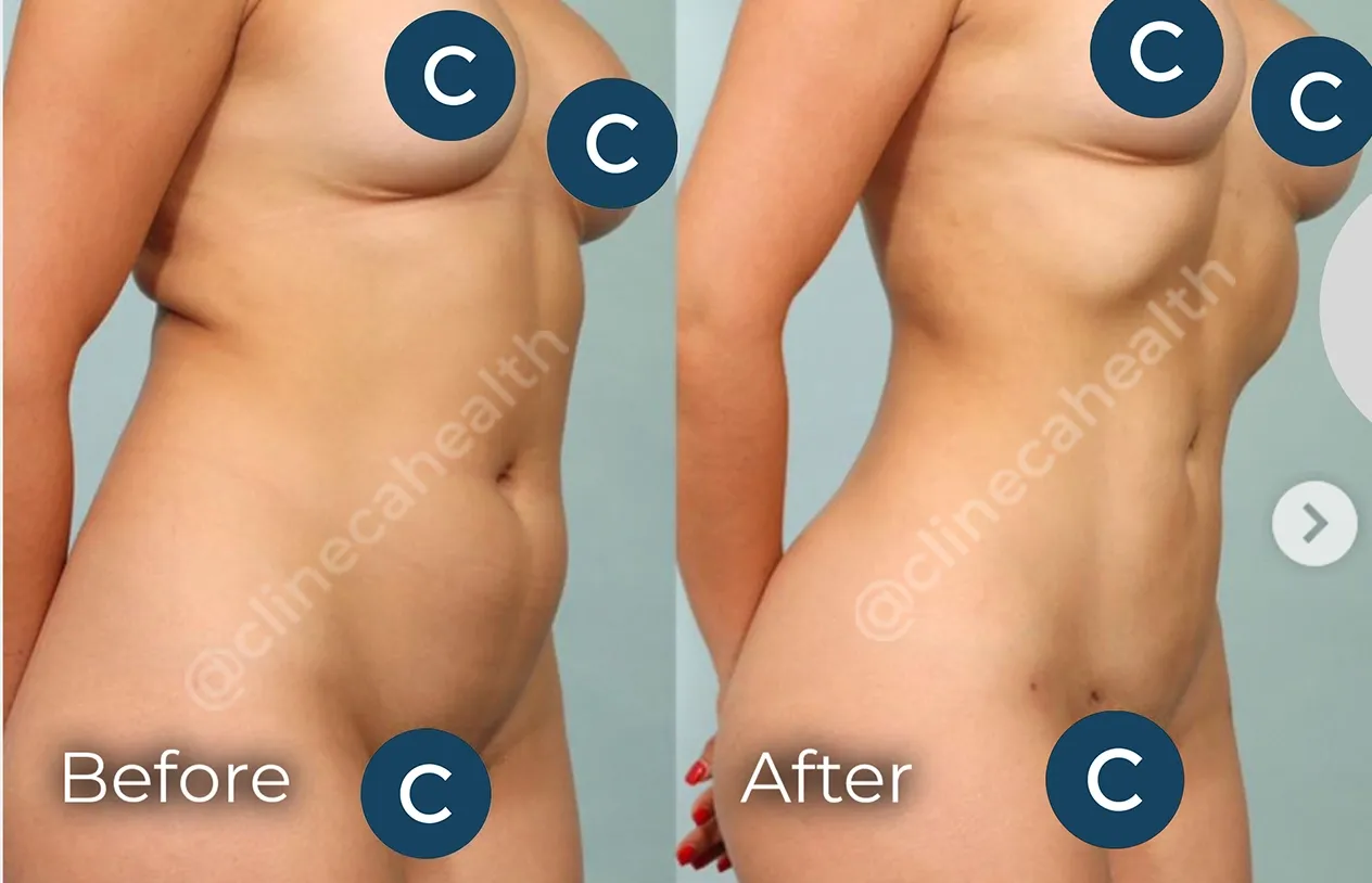 Liposuction — before and after