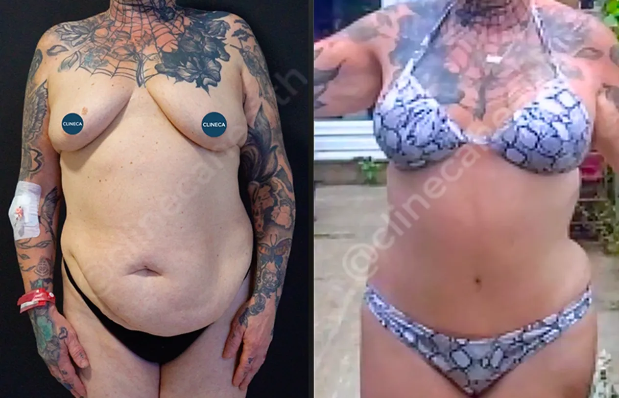 Mommy Makeover — before and after