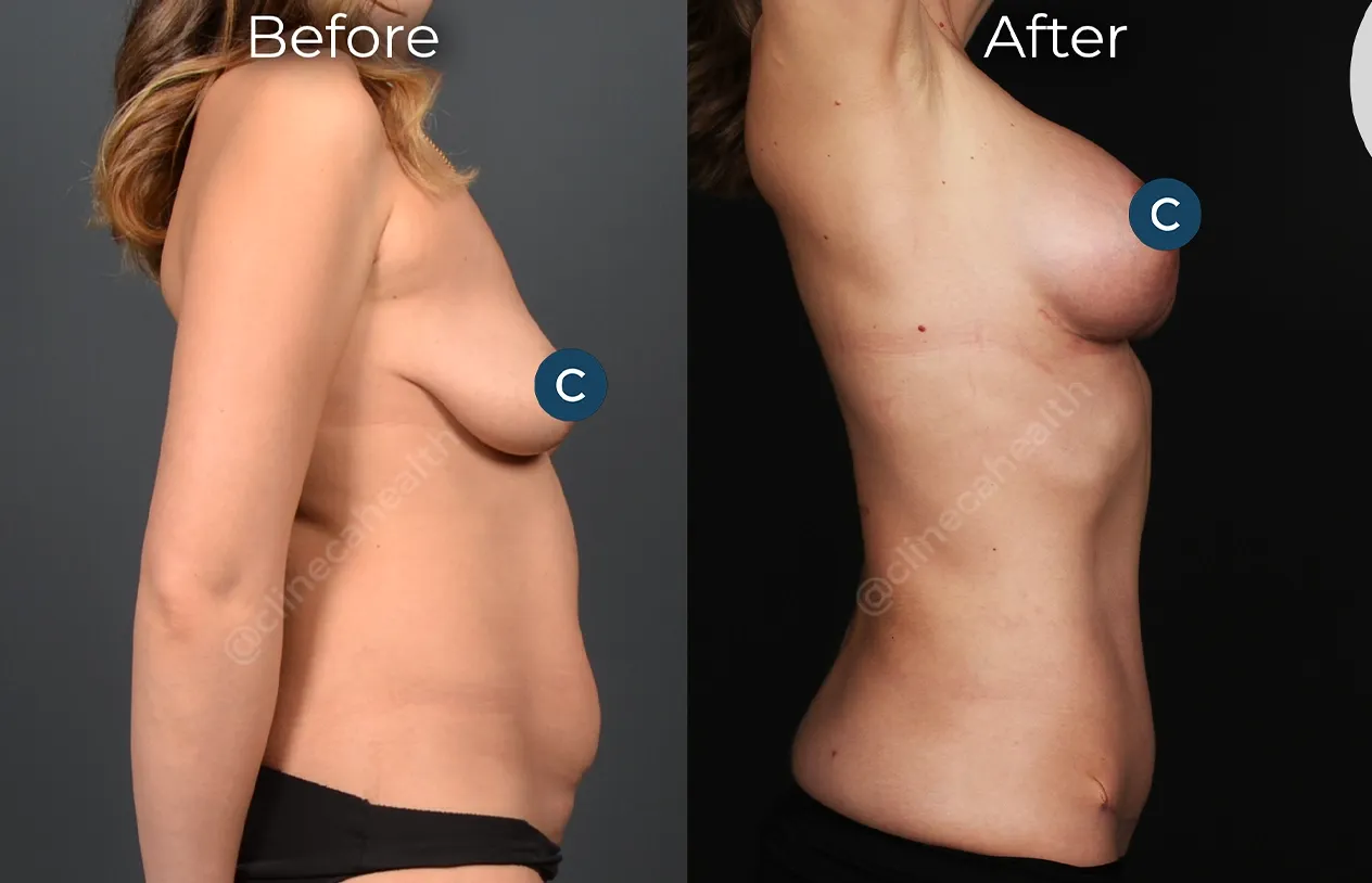 Mommy Makeover — before and after