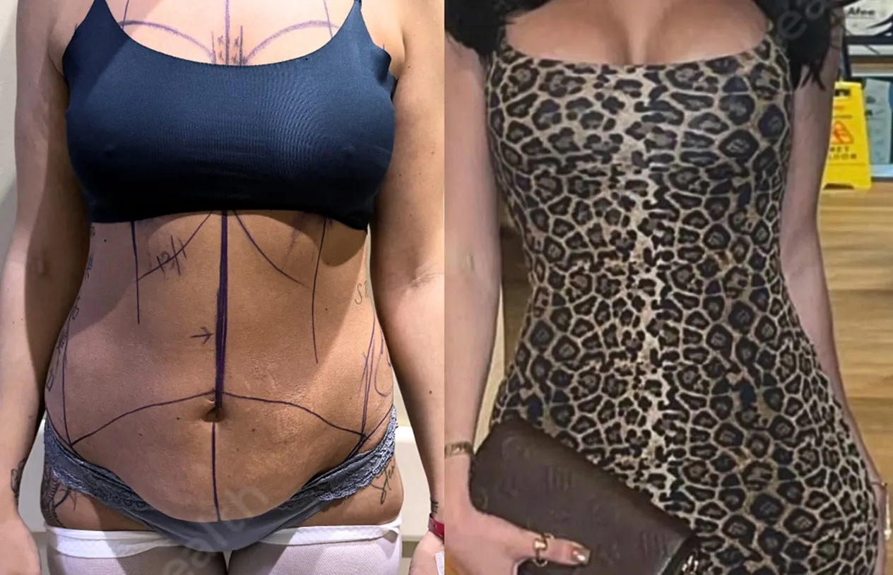 Mommy Makeover — before and after