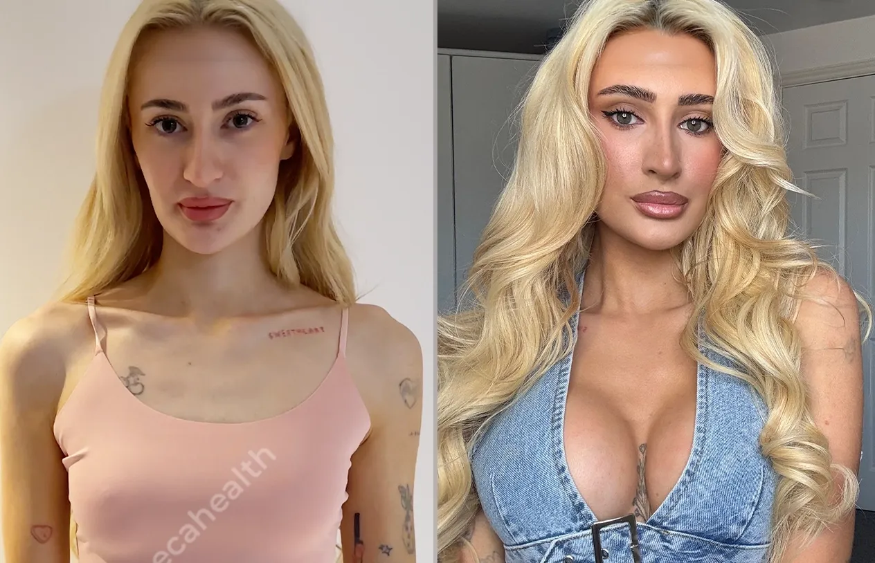 Breast Augmentation — before and after