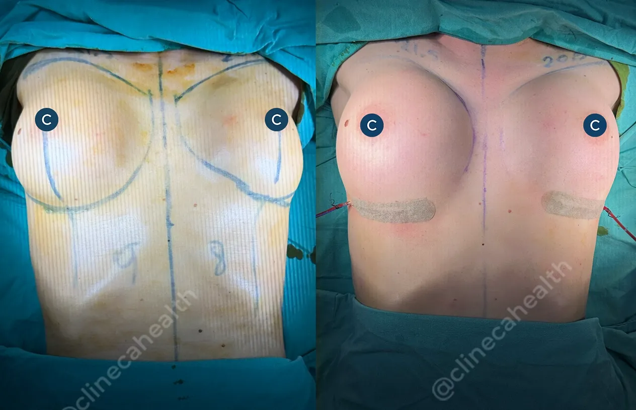 Breast Implant Revision — before and after