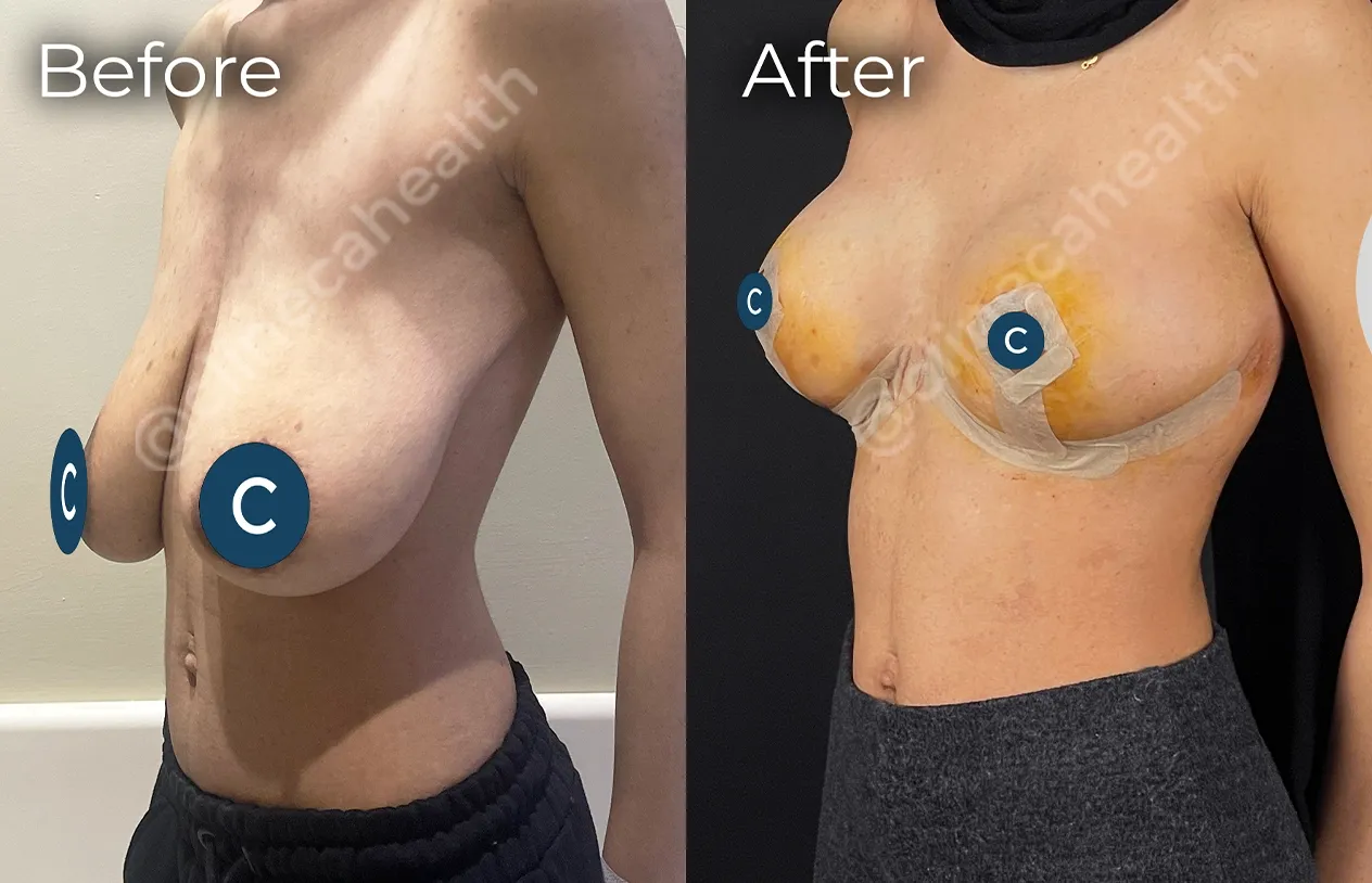 Breast Reduction — before and after