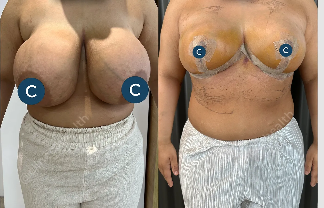 Breast Reduction — before and after