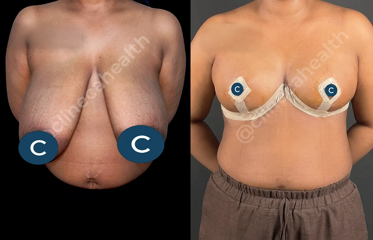 Breast Reduction — before and after