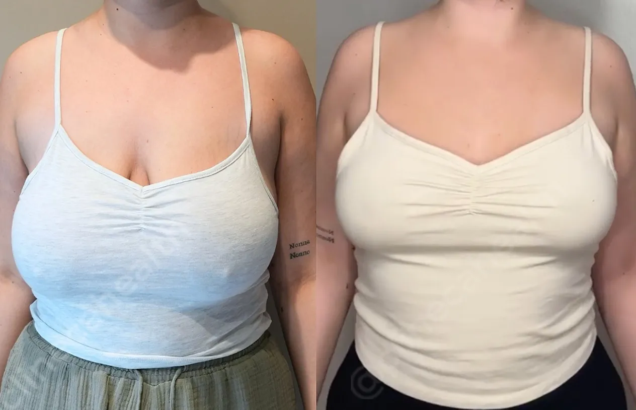 Breast Reduction — before and after