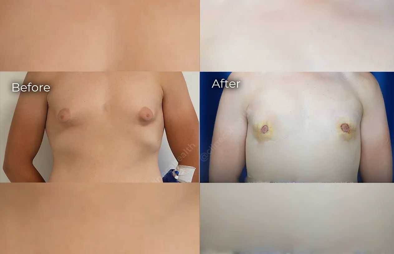 Gynecomastia Surgery — before and after
