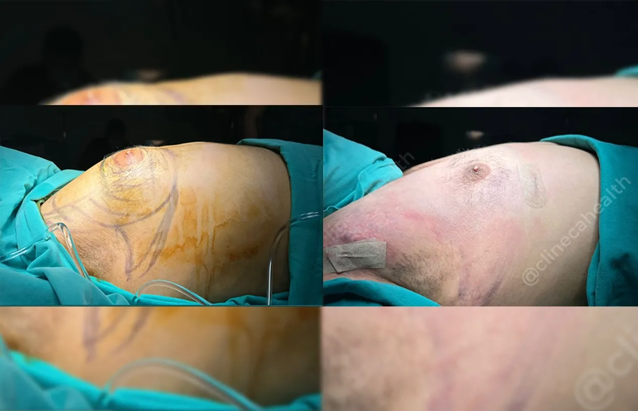 Gynecomastia Surgery — before and after