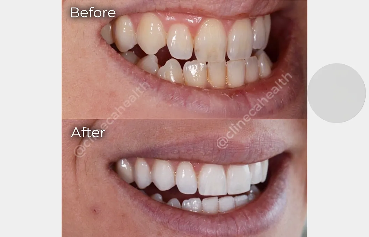 Bonding — before and after