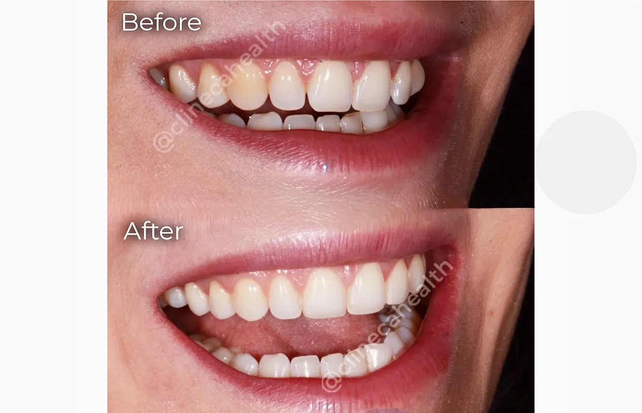 Bonding — before and after