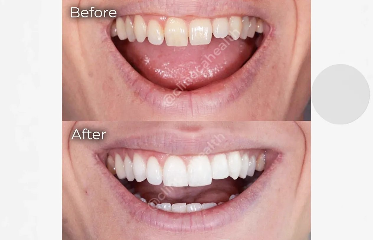 Bonding — before and after