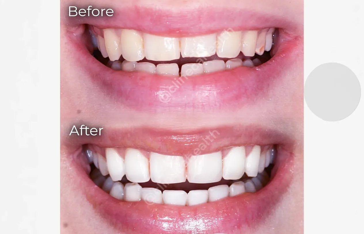Bonding — before and after