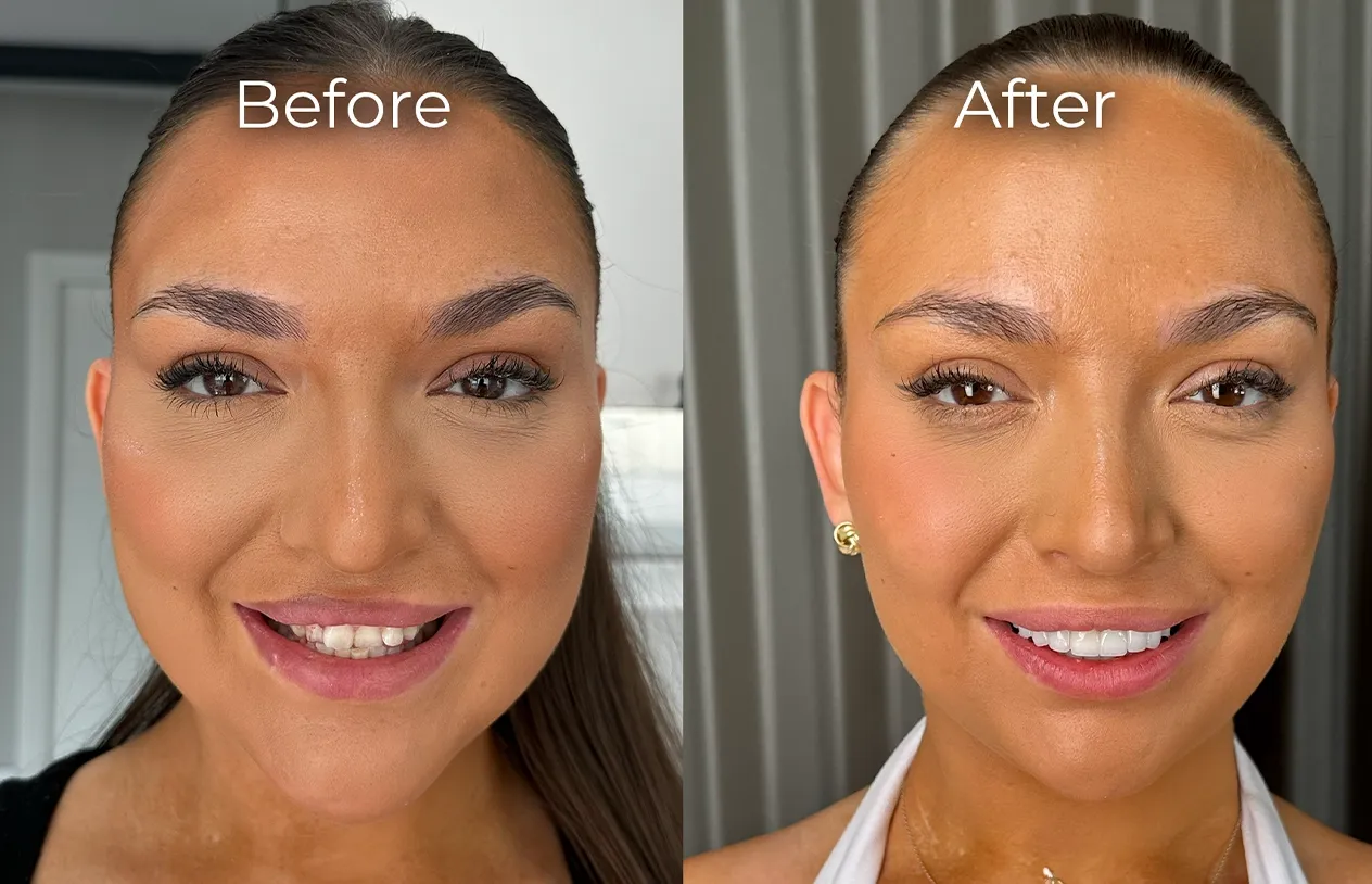Dental Crowns — before and after