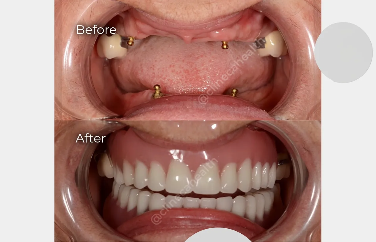 Dental Implants — before and after