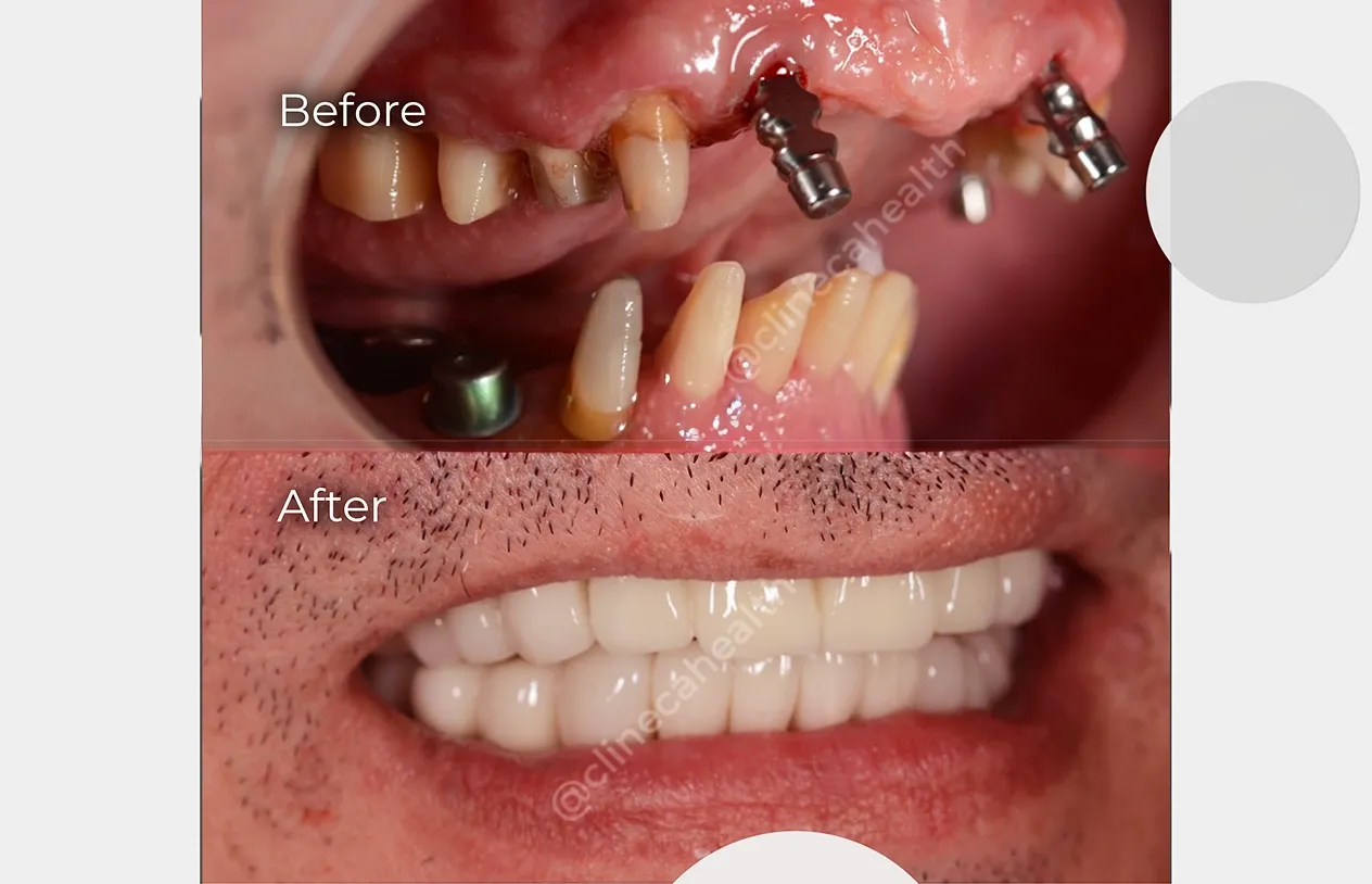 Dental Implants — before and after