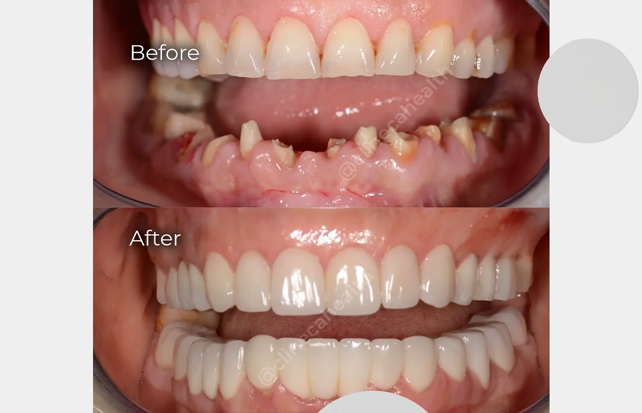 Dental Implants — before and after