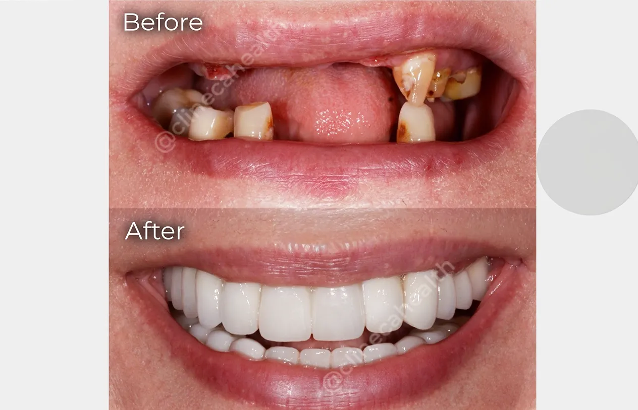 Dental Implants — before and after