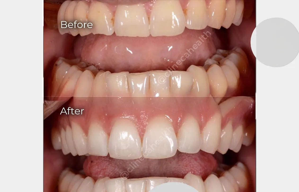 Teeth Whitening — before and after