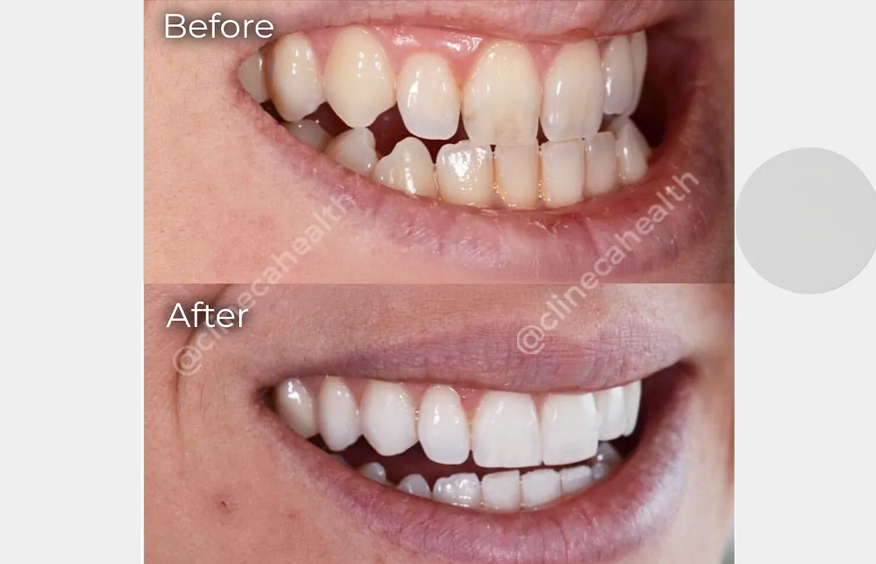 Teeth Whitening — before and after