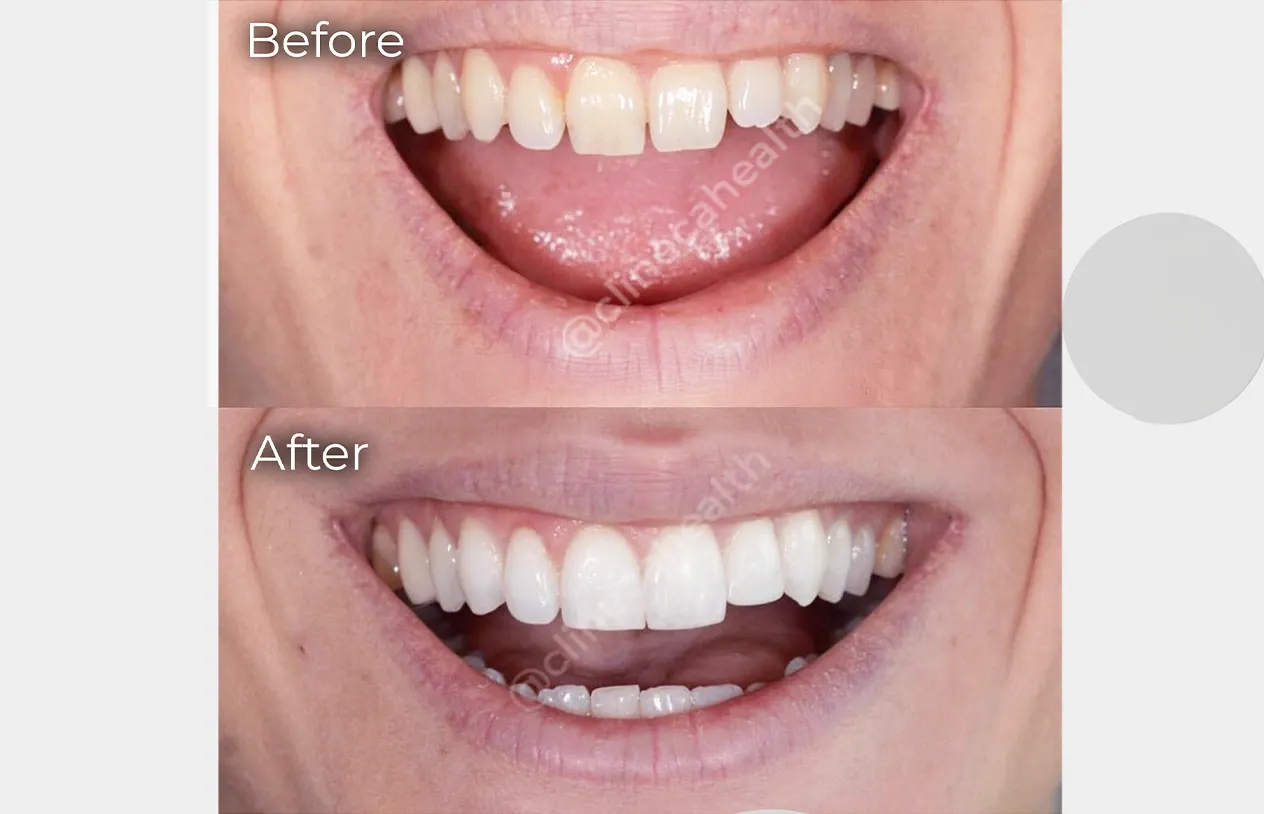 Teeth Whitening — before and after