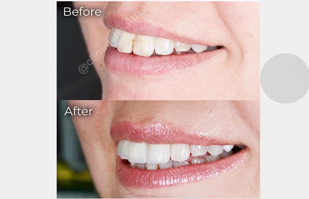 Teeth Whitening — before and after